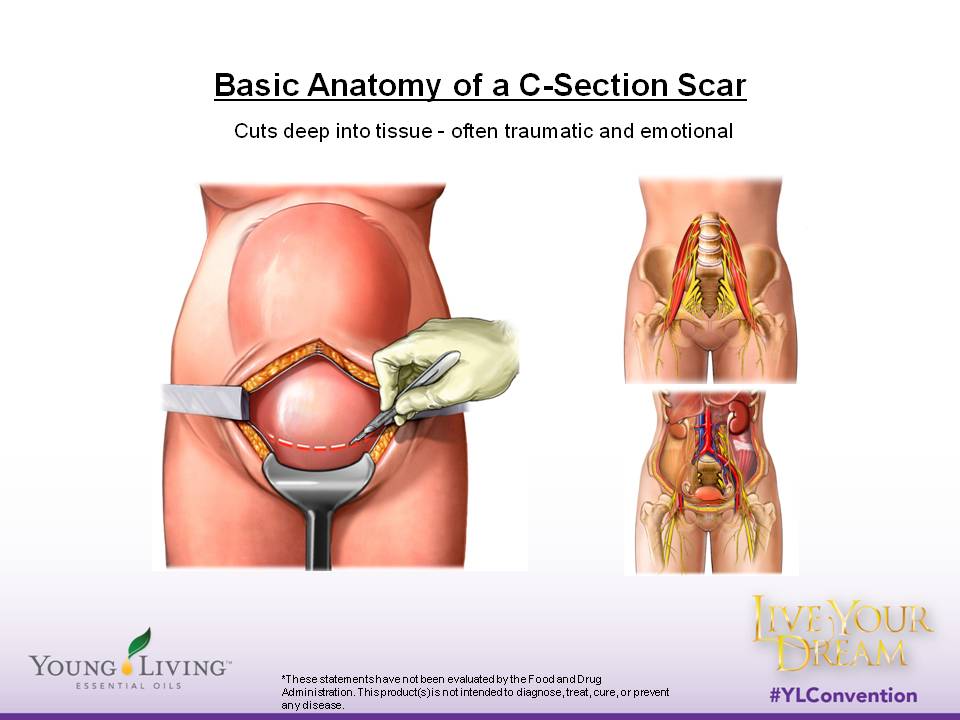 cesarean section anatomy